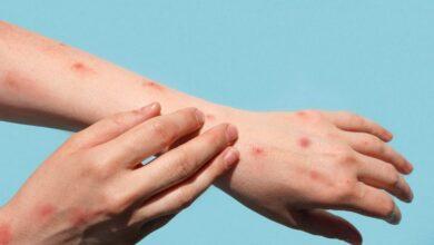 Chikungunya spread in Telangana.. America warns