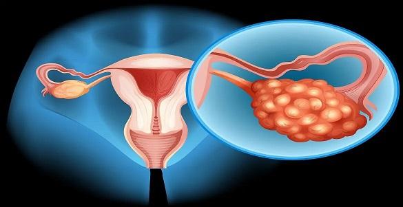 Why does PCOD/PCOS occur? How can it be prevented?