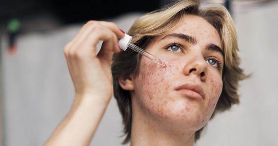 Why do pimples appear on the skin? What should be done to reduce them?