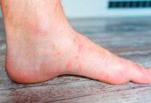 Getting wet in the rain can lead to fungal infections!