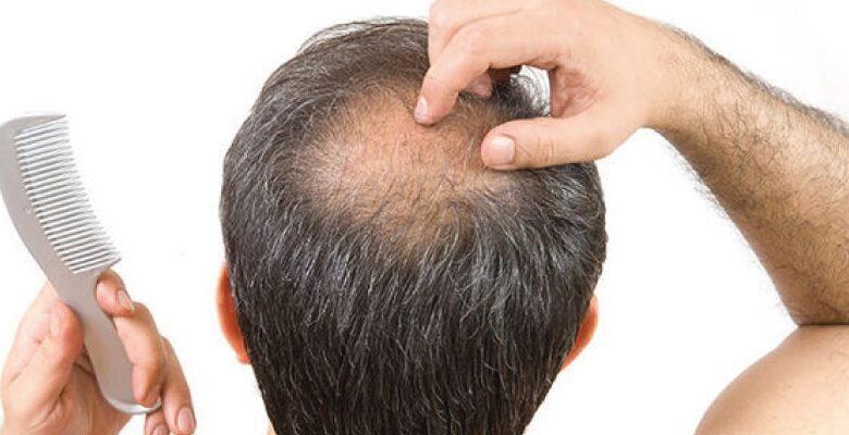 Why does baldness occur only in men?