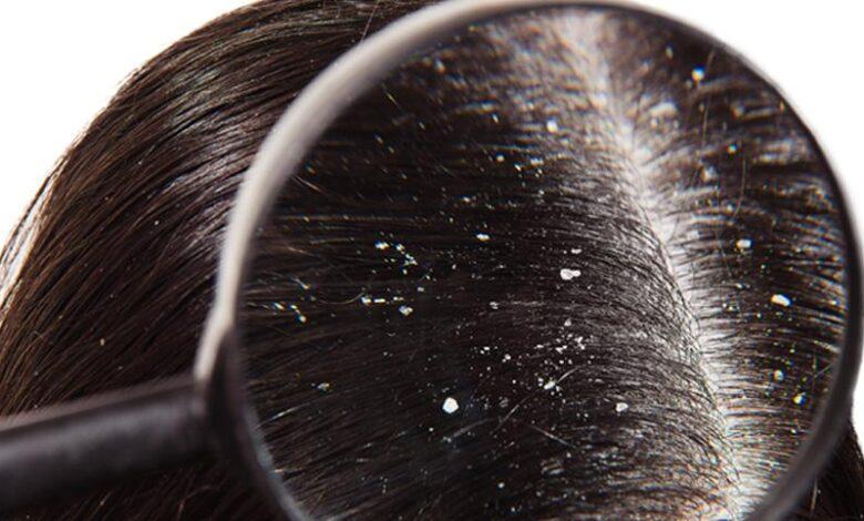 These are the mistakes you make that cause dandruff to increase