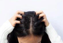 The ‘dark’ fact behind dandruff shampoos.