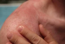 Why Do Heat Rashes Occur in Summer?
