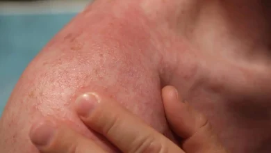Why Do Heat Rashes Occur in Summer?