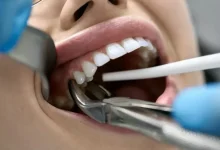 Fears About Tooth Extraction..! What Do Doctors Say?
