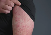 What is sepsis? Why is it life-threatening?